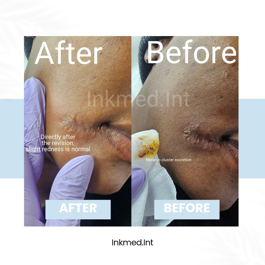 Before and after scar revision treatment by Inkmed.INT