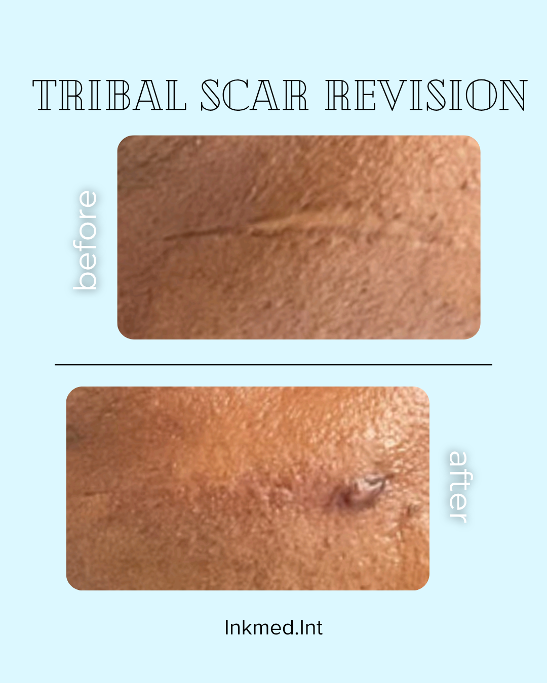 Tribal scar revision before and after treatment by Inkmed.INT